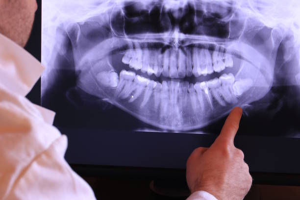 Best Emergency Wisdom Teeth Removal in Sedalia, MO